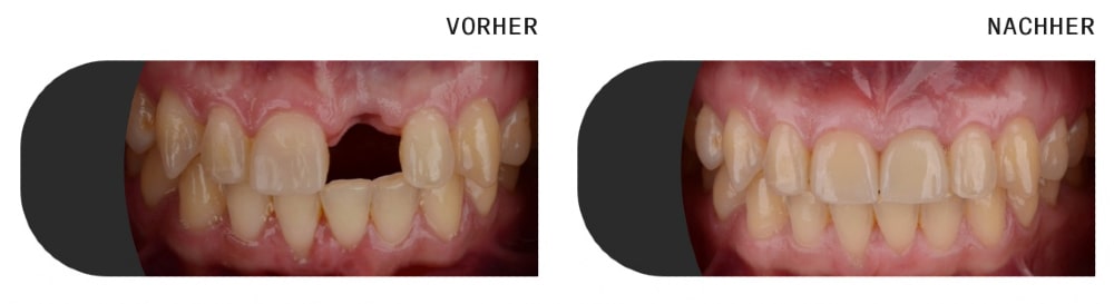 Implantate Mainz - Einzelzahnersatz bei DentalGut Klein-Winternheim