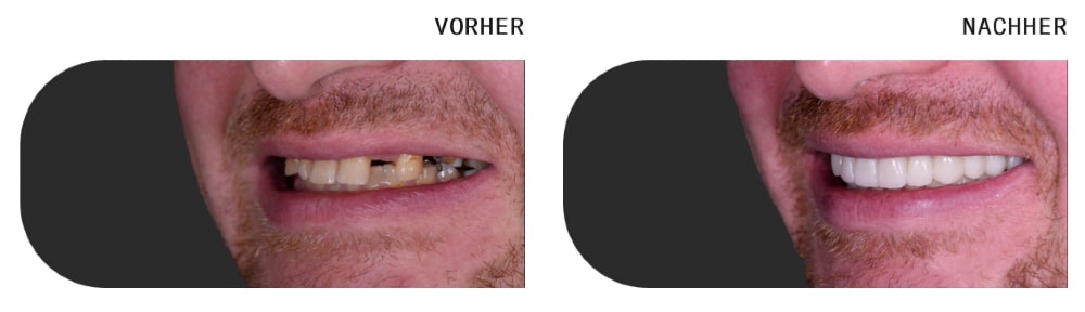 Implantate Mainz - Zahnersatz wenn mehrere Zähne felen bei DentalGut Klein-Winternheim