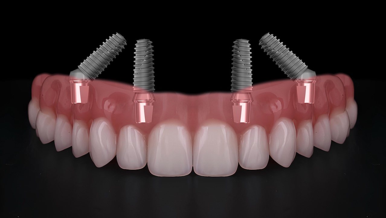 Implantatmethode, basierend auf dem All on four- und All on six-Konzept in Mainz bei Dr. Tomalla