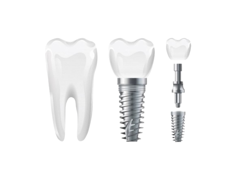 Was sind Zahnimplantate - Aufbei eines Implantates - Implantologie Mainz bei DentalGut